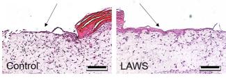 Example Hematoxylin and Eosin stained human full-thickness epidermis wound models following either no treatment or a 2 minute treatment with LAWS, demonstrating improved regrowth of the epithelial tongue (indicated with the arrows) following LAWS treatment.